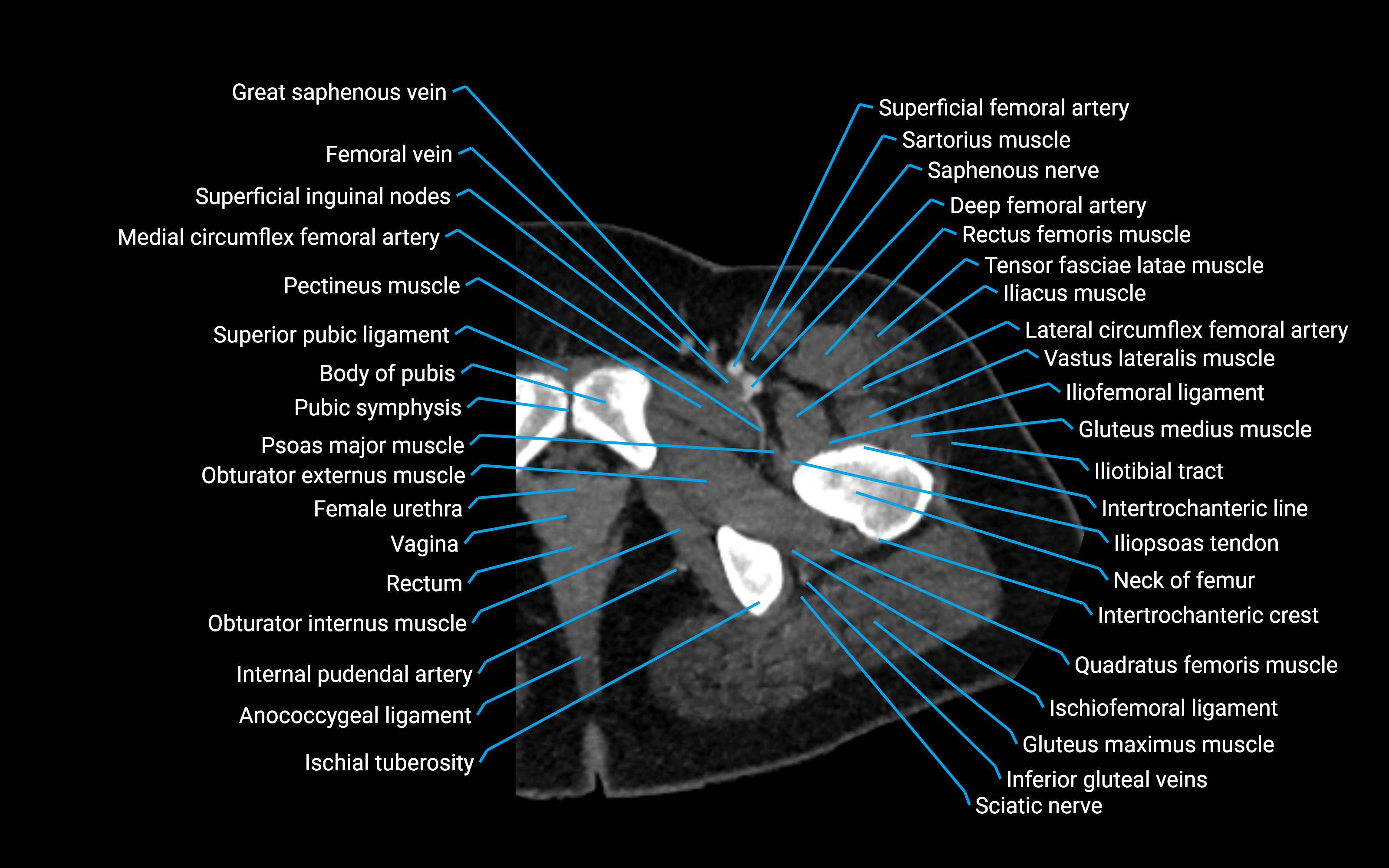 CT Hip axial cross sectional anatomy labelled image 13 (1).png